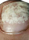 White-superficial-Onychomycosis