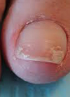 white-superficial-onychomycosis2